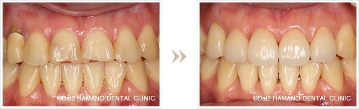 前歯5本の症例
